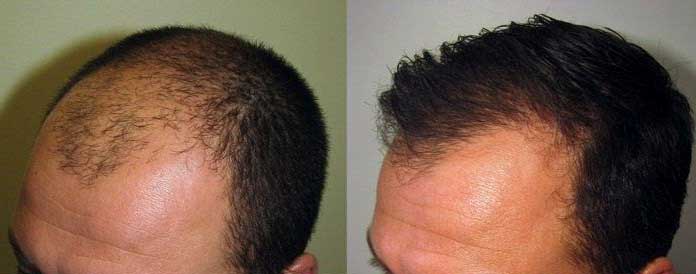 Hair Density Improvement – Skin Hair and Body Clinic